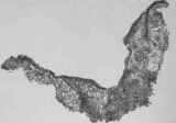 Showing the entire cross section of an excised ulcer as it appear under the lens.