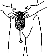 Center bag and quickly press into place over artificial bladder opening