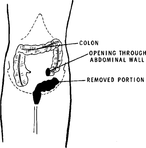 SINGLE BARREL COLOSTOMY