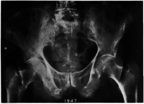 8 years after orchiectomy