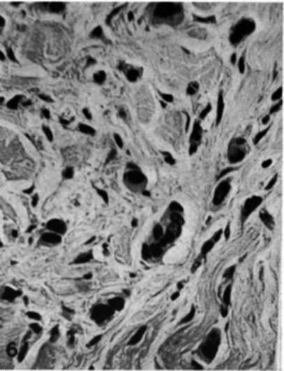 Biopsy from dermal plaque of recurrent mammary cancer in a mastectomy scar 35 days after adrenalectomy