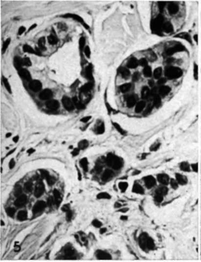 Biopsy from dermal plaque of recurrent mammary cancer in a mastectomy scar