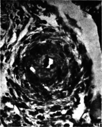 Kidney from a rat bearing regenerating adrenal cortical tissue