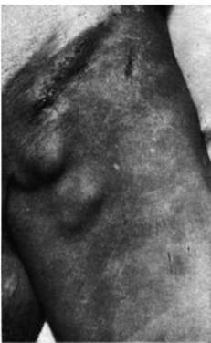 Metastases of cancer of prostate in inguinal lymph nodes
