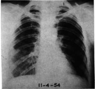 Metastases of cancer of the breast to lung and pleura