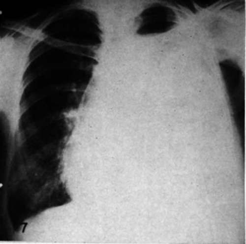 Metastatic carcinoma of the breast causing hemothorax in a woman