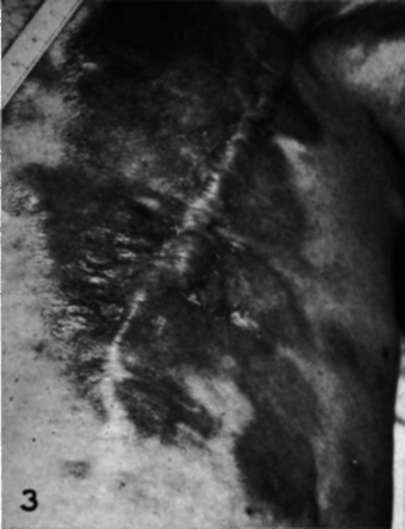 Recurrent carcinoma in a mastectomy scar in a woman