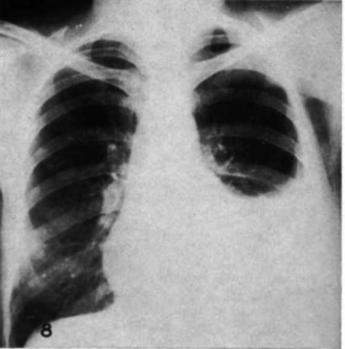 Roentgenogram of thechestof a woman with metastatic mammary cancer