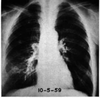 Same patient 5 years after adrenalectomy