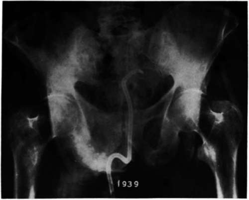 widespread cancer of the prostate