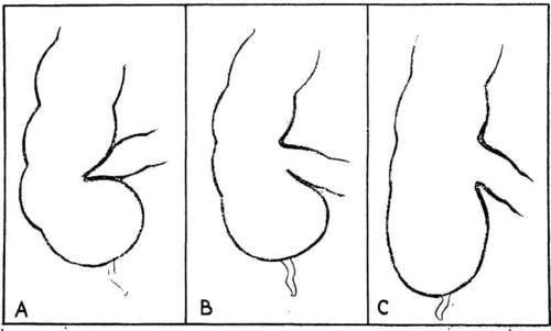 A. Normal Ileocecal Valve. B. Partially Incompetent Ileocecal Valve.