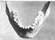 Lower jaw of a Malkelkos Indian.