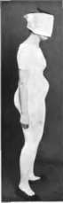 Relaxed protuberant abdomen, a result of bad sitting position and relaxed muscles.