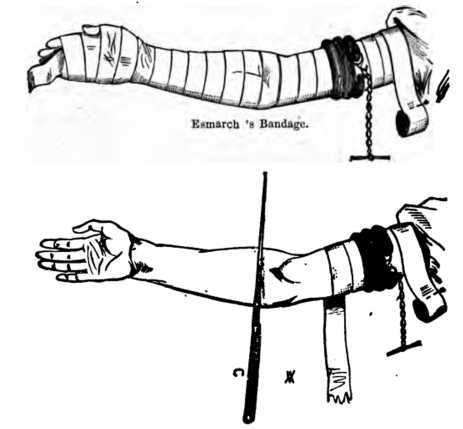 Fig. 391. Amputation of the Arm.