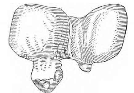 Fig. 292. Liver Deformed by Compression.