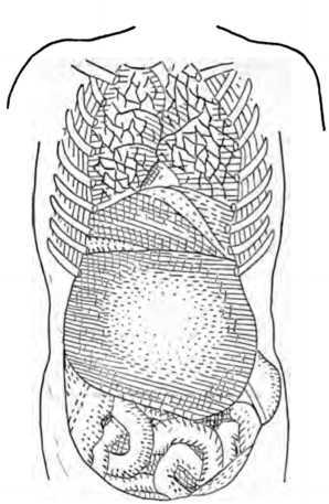 Fig. 294. Liver Displaced by Compression.