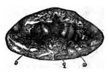 Fig. 298. Ulceration of the Larynx.