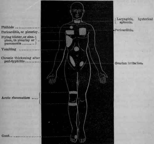 Fig. 226. Diagram of the body showing some of the points where blisters or sinapisms are usually