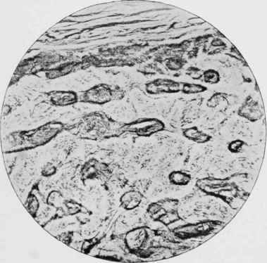 Transverse section of the abnormal bone in Fig. 5 Same magnification as in Fig. 6. Unstained.