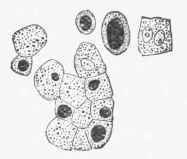 Cells of Mammary Gland during lactation, stained with osmic acid so as to show the various sized oil globules as black masses.