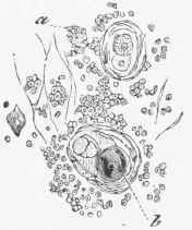 Elements of Thymus (high power). (Cadiat.) (a) Lymph corpuscles, (b) Epithelioid nests of Hassall.