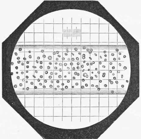 The appearance presented by the Capillary lube of Malassez Apparatus when filled with diluted blood.