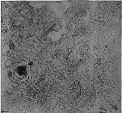 Treponema pallidum in the Brain of General Paralysis