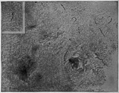 Treponema pallidum in the Brain of General Paralysis.