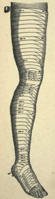 BANDAGED LIMB.