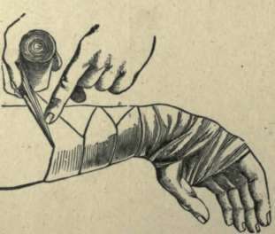 REVERSING BANDAGE.