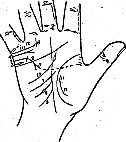 Plate XVIII. Marriage Lines And Influence Lines Which Further Help In Denoting Marriage.