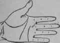 Deafness Wound In The Legs 80
