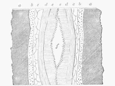 Fissure Vein with Cavity of Tug at Centre.