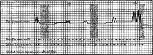 Curve of Periodicity of Recurrence of natural desire in healthy causes